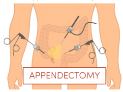 Appendectomy