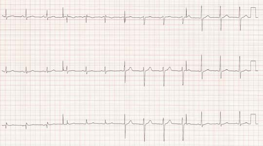 ischemic heart disease case study ppt ECG-women