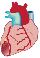 ischemic heart disease case study ppt heart